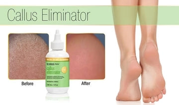 Prolinc Be Natural callus eliminator orange formula order online Canada